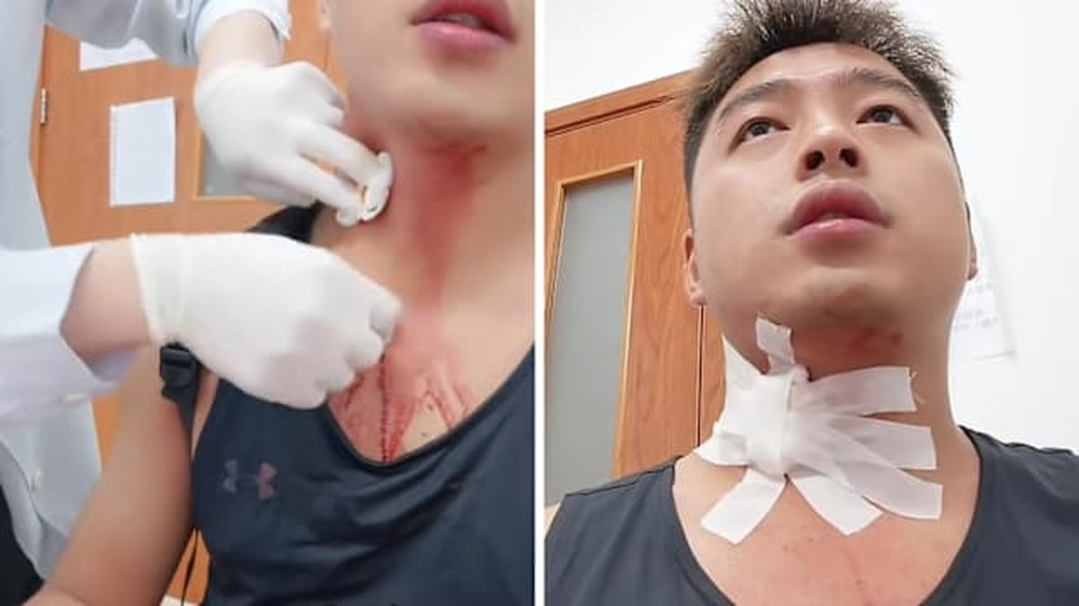 Câu Chuyện Hy Hữu: Vết Đốt Muỗi Gây Chảy Máu Nghiêm Trọng Tại Trung Quốc